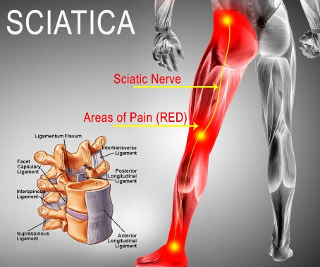 What is sciatica, and how can it be treated