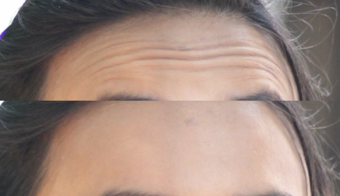 How Can I Get Rid Of Wrinkles On My Face Fast
