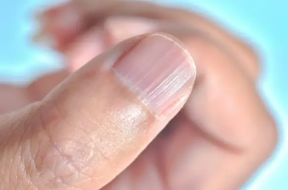 Ridges in Nails: Horizontal, Vertical, Causes & Treatment