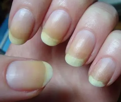 What can you do about yellow nails