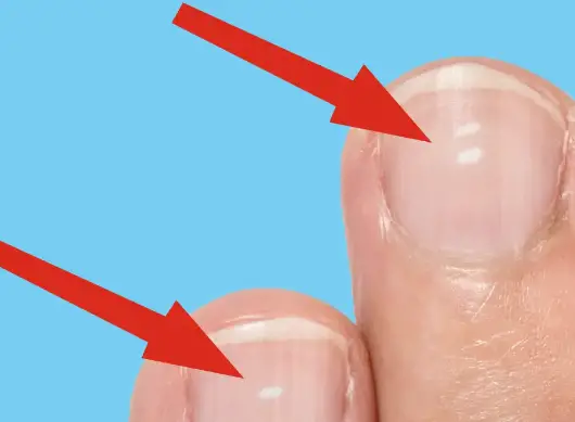What's Causing White Spots on Your Nails