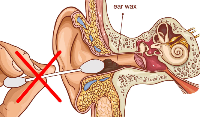 Is Earwax Removal Safe