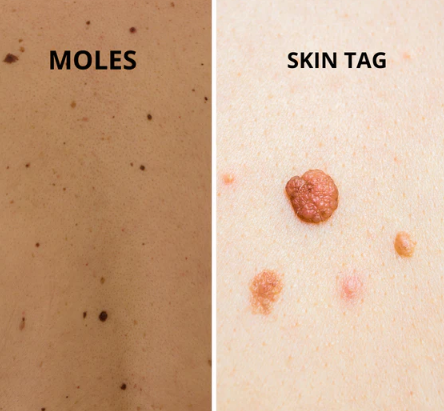 Mole Vs. Skin Tag: Understanding the Difference 