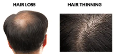 Hair Thinning vs Hair Loss 
