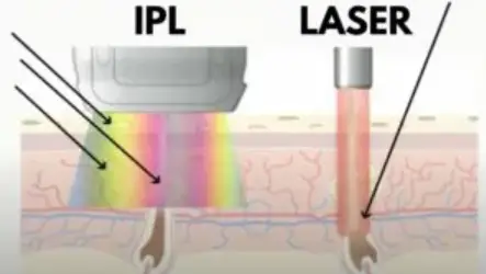 What is IPL Hair Removal?
